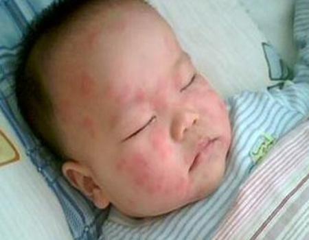 孩子退烧后怎么护理
