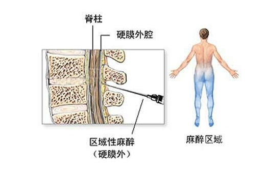 剖腹产打麻药打哪里