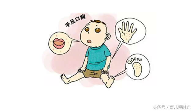 手足口病不吃药能自愈吗