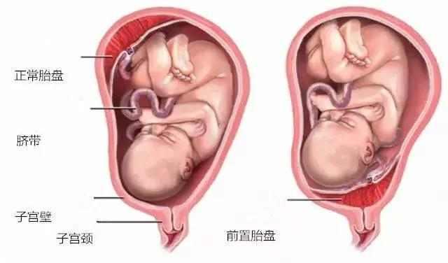 前壁胎盘的胎儿图片图片