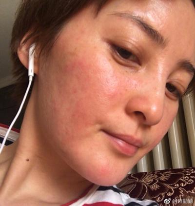 婴儿皮肤过敏需要注意什么