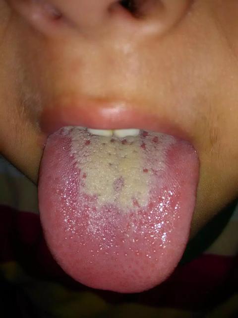 小儿食积会引发这些病