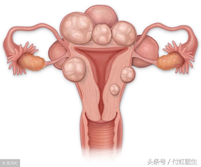 绝经后查出子宫肌瘤怎么办