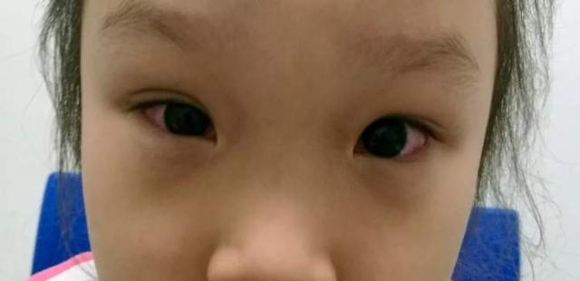 孩子的眼屎特别的多正常吗