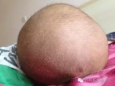 宝宝总是流汗是新陈代谢旺盛吗
