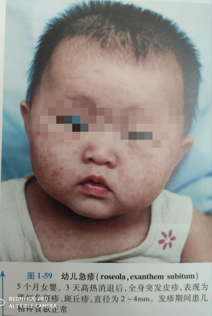幼儿急疹了怎么办