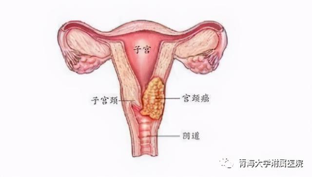 世卫组织称HPV疫苗可消除宫颈癌是真的吗 世卫组织称HPV疫苗可消除宫颈癌是真的吗