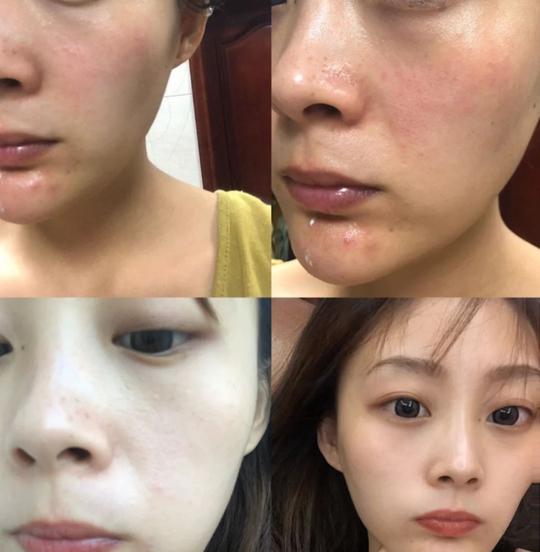 “抖音毒面膜”毁脸再曝光！居然还有人跟风买