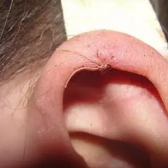 西安破伤风疫苗相关长尾关键词有哪些