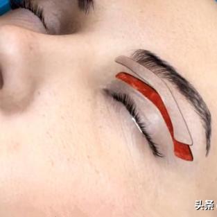 眼皮松弛做什么手术的长尾关键词有什么