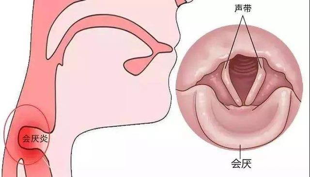 儿童会厌炎有哪些症状