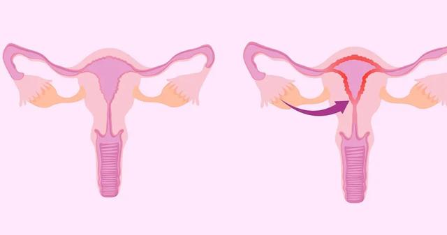 子宫内膜薄吃什么好 子宫内膜薄吃什么好