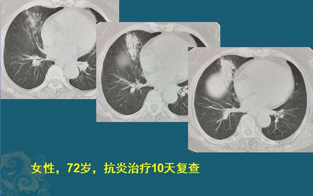 七岁男孩反复肺炎经检查多长了一个肺