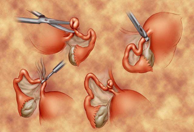 上环后怀孕该怎么办 上环后怀孕该怎么办
