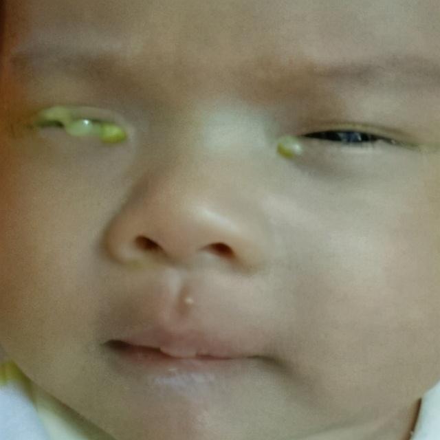 孩子睡醒后的眼屎怎么洗