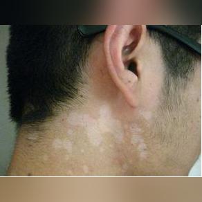 广州最好的白癜风医院相关长尾关键词有哪些