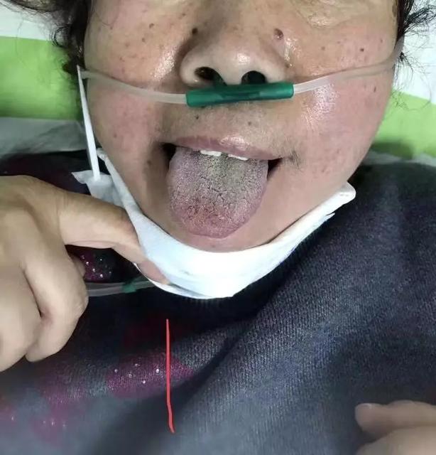 今年流感的主要症状是什么