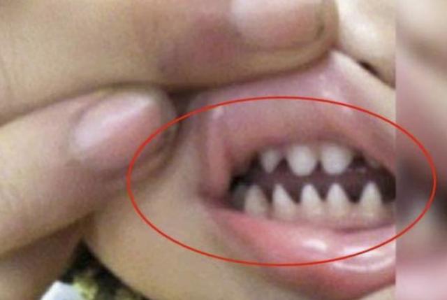 孩子长鲨鱼牙怎么办