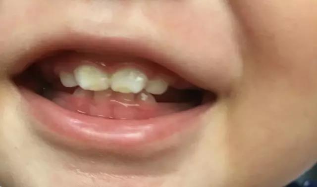 长牙期的宝宝该如何护理