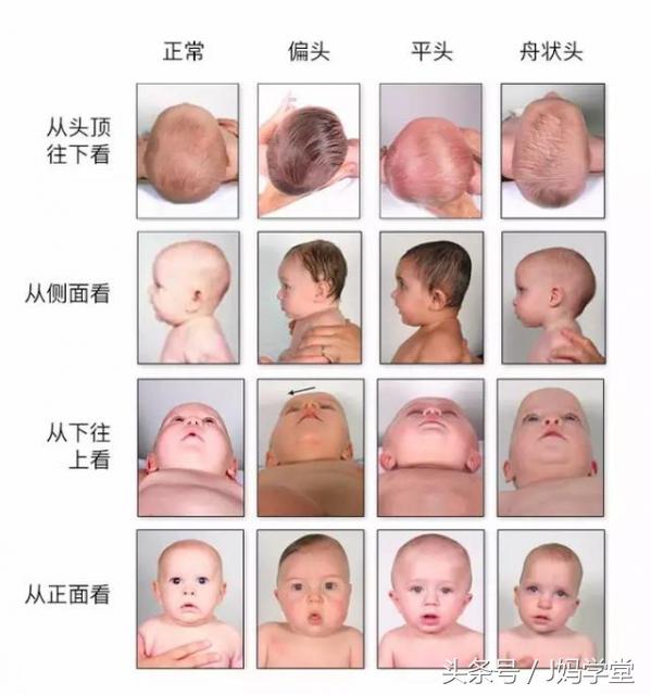 孩子头型偏了会影响宝宝吗