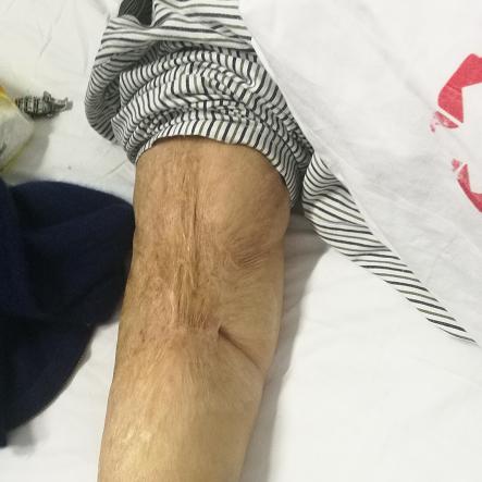 哈尔滨好疤痕医院排名相关长尾关键词有哪些