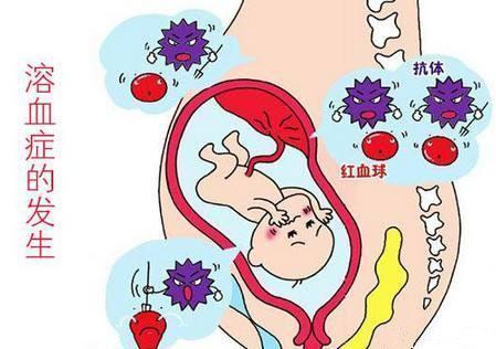 孕期怎么检查胎儿溶血