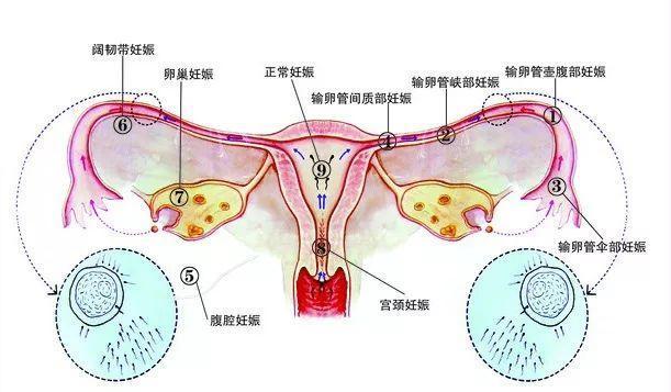 宫外孕特征有哪些