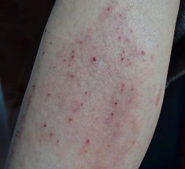 【二次感染有什么症状
 ,梅毒二次感染有什么症状】