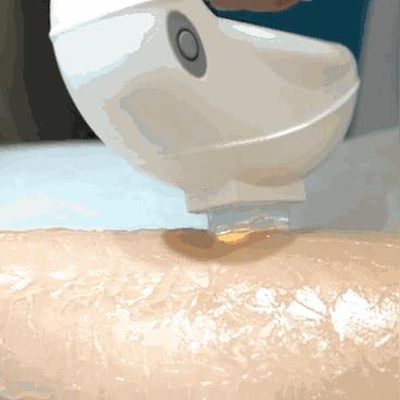 天津脱毛哪个好