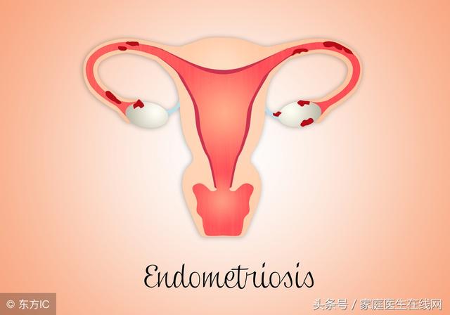 子宫脱垂是怎么引起的 子宫脱垂是怎么引起的