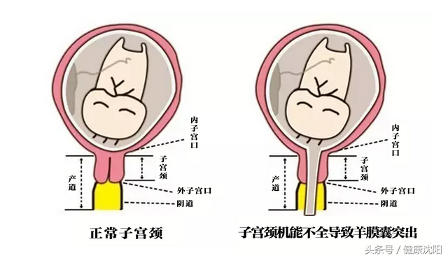 孕中期可以抑制宫缩吗