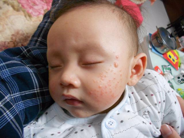 宝宝长痱子了可以开空调吗