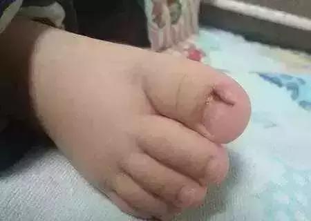 宝宝甲沟炎是怎么回事