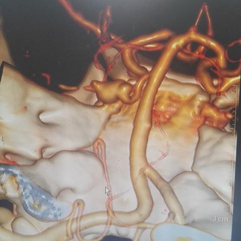 河南血管栓塞的相关长尾关键词有哪些