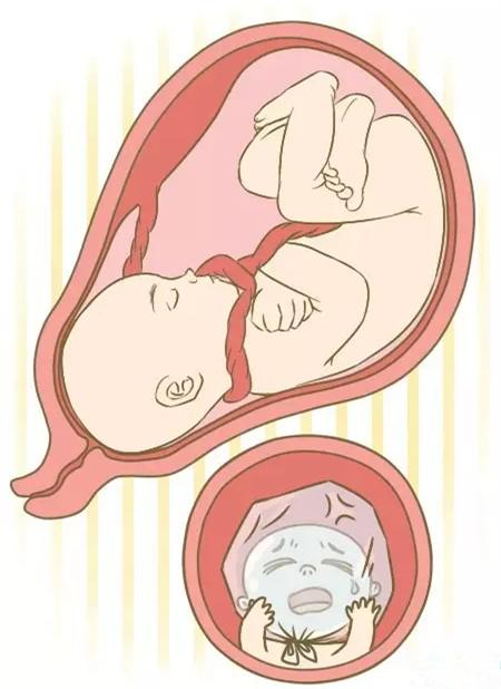 脐带打结对胎儿的影响