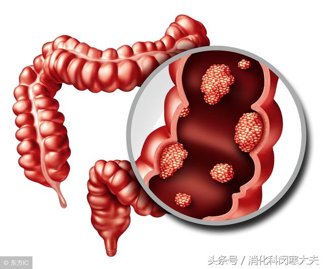 如何防止子宫内膜息肉复发