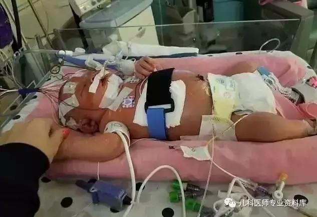 流行性乙型脑炎会传染吗