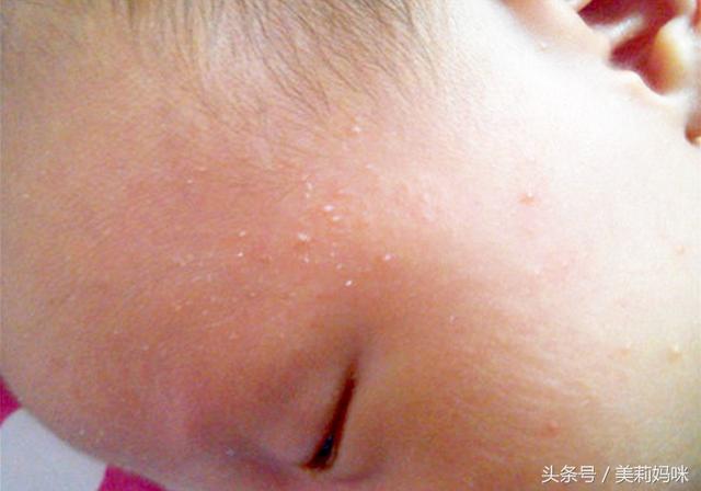 新生儿鼻尖上起了好多小白点是什么 新生儿鼻尖上起了好多小白点是什么