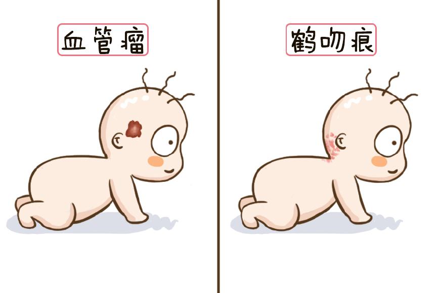 怎样让吻痕一晚上消失(宝宝鹤吻痕怎么办)