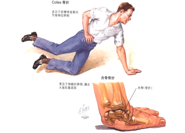 宝宝骨折预防和正确的调理方法