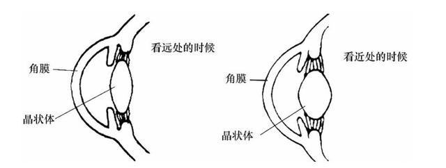 屈光不正严重不