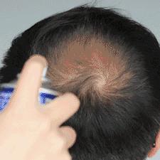 济南哪里植发好相关长尾关键词有哪些