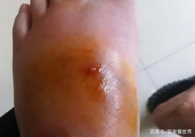 村民被红火蚁咬后休克怎么回事 村民被红火蚁咬后休克怎么回事