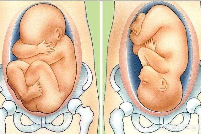 胎儿胎位不正怎么办