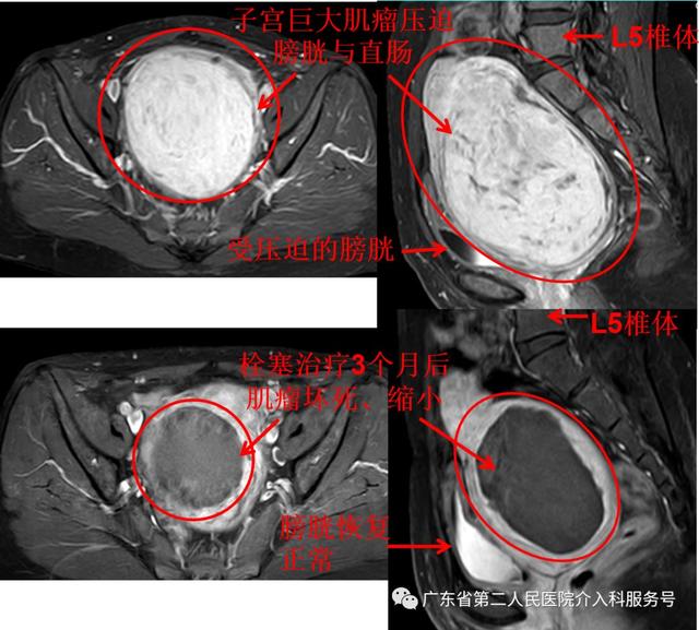 介入子宫肌瘤怎么做手术吗