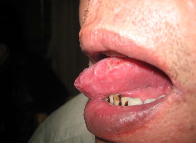 适合口腔溃疡朋友圈发心情说说