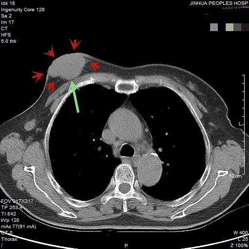 切掉乳房就能预防乳腺癌吗 切掉乳房就能预防乳腺癌吗