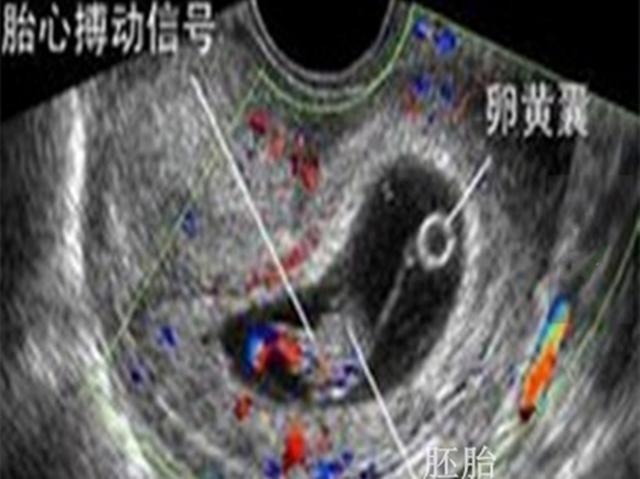 孕妇产检时为什么被问头胎还是二胎