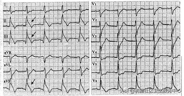 什么是心源性猝死 什么是心源性猝死