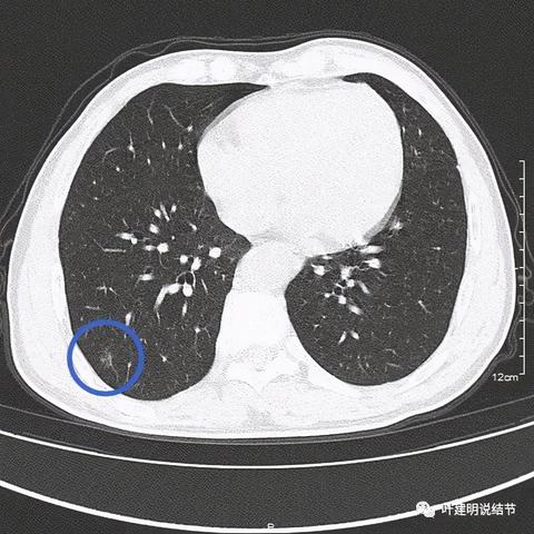 江苏苏州常熟银行肺节结的长尾关键词有什么